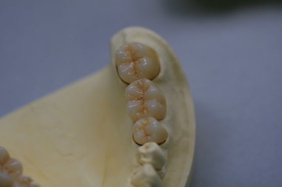 De tand van het het Porseleinzirconiumdioxyde van het Laboratoriumzirconiumdioxyde Tandkroon met Ceramisch