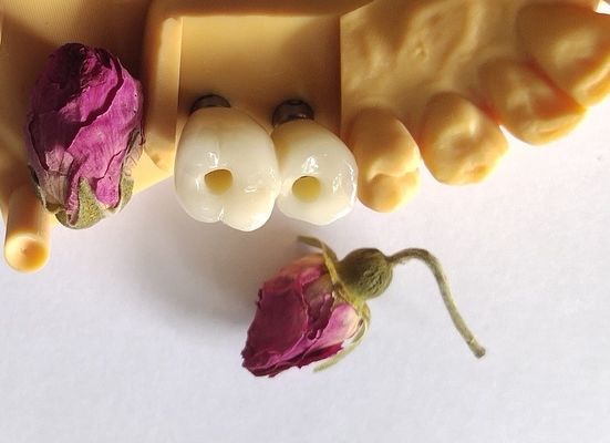 Gecementeerde Implants Kronenbruggen