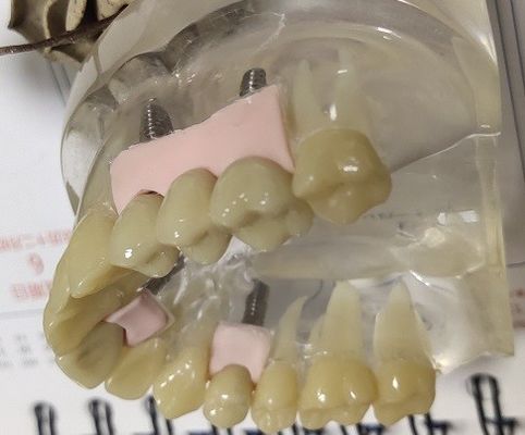 De Voorlopige Kroon van 100 Percentenbiocompatibility PMMA