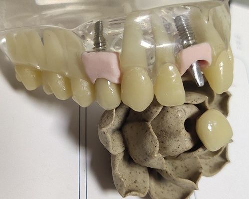 Binnen de Kroon Tand 3D Druk van het metaal Lege Malen PFM