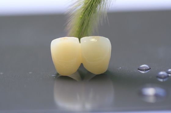 3D Tand het Laboratoriumkroon van het Drukkader PFM voor Tandheelkunde