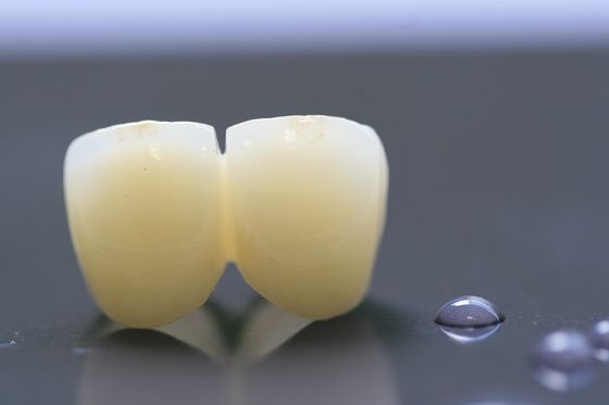 3D Tand het Laboratoriumkroon van het Drukkader PFM voor Tandheelkunde