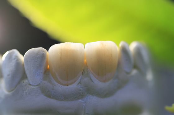 3D Tand het Laboratoriumkroon van het Drukkader PFM voor Tandheelkunde